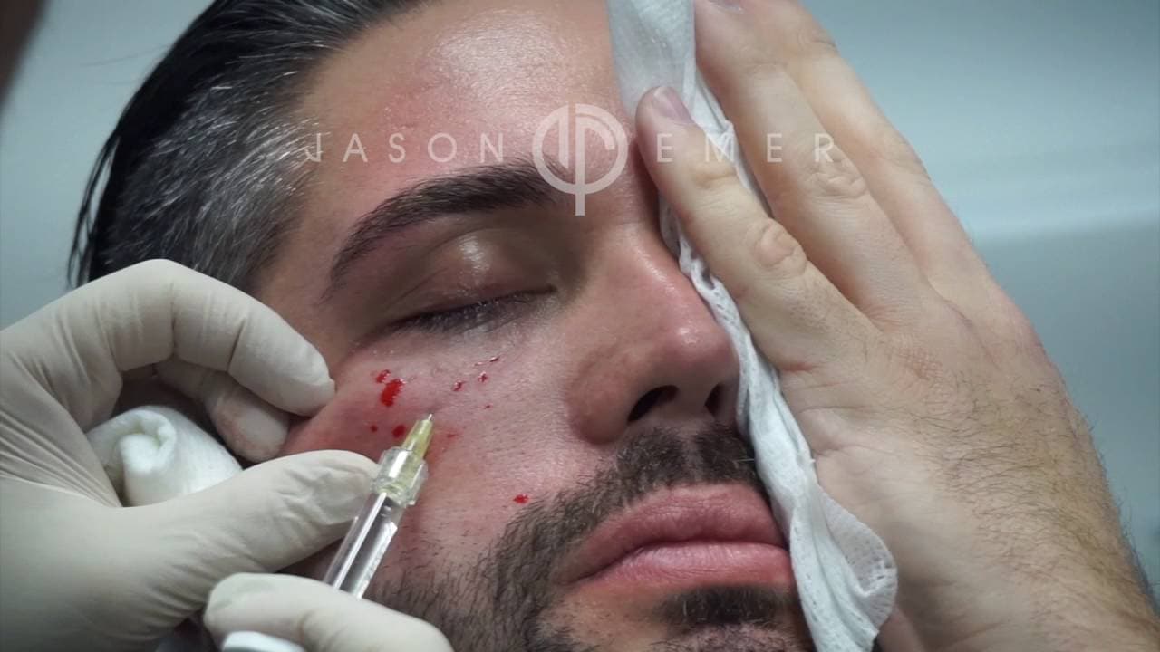 Watch a rejuvenate with injectable fillers procedure video