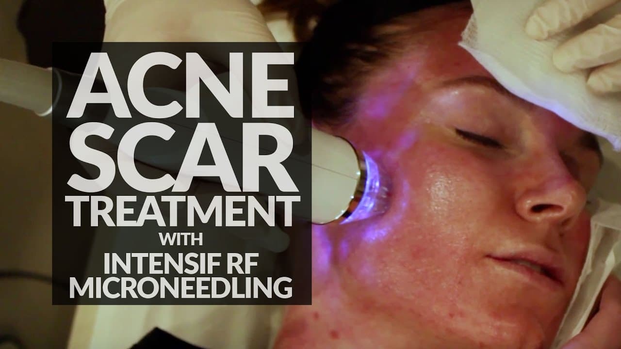 Acne Scar Treatments procedure video