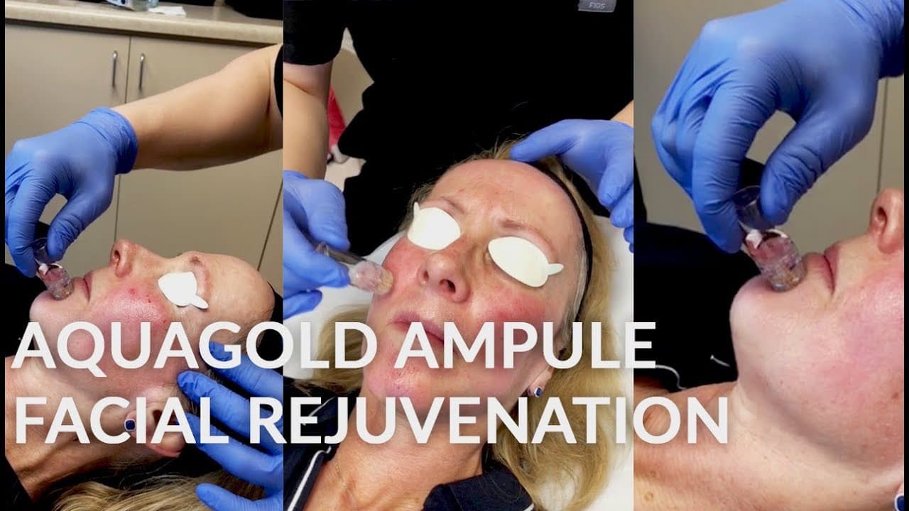 MicroChannel Infusion Therapy procedure video