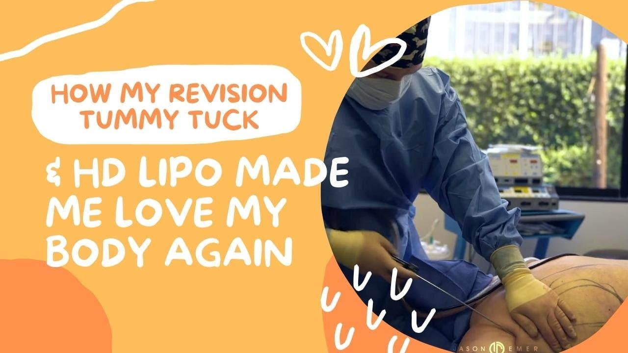 Watch a abdominal lipo for women procedure video