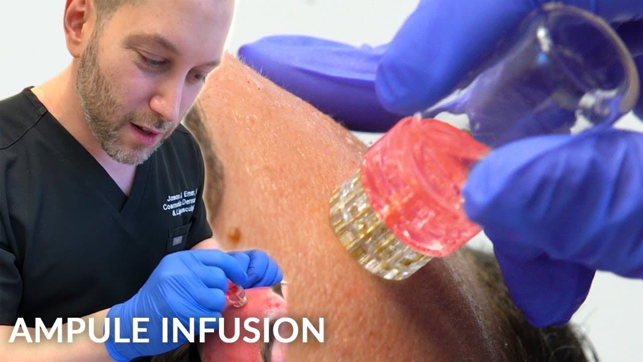 MicroChannel Infusion Therapy procedure video