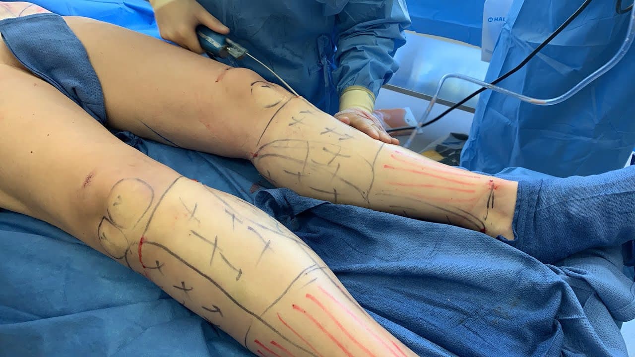 Watch a calf sculpting for women procedure video