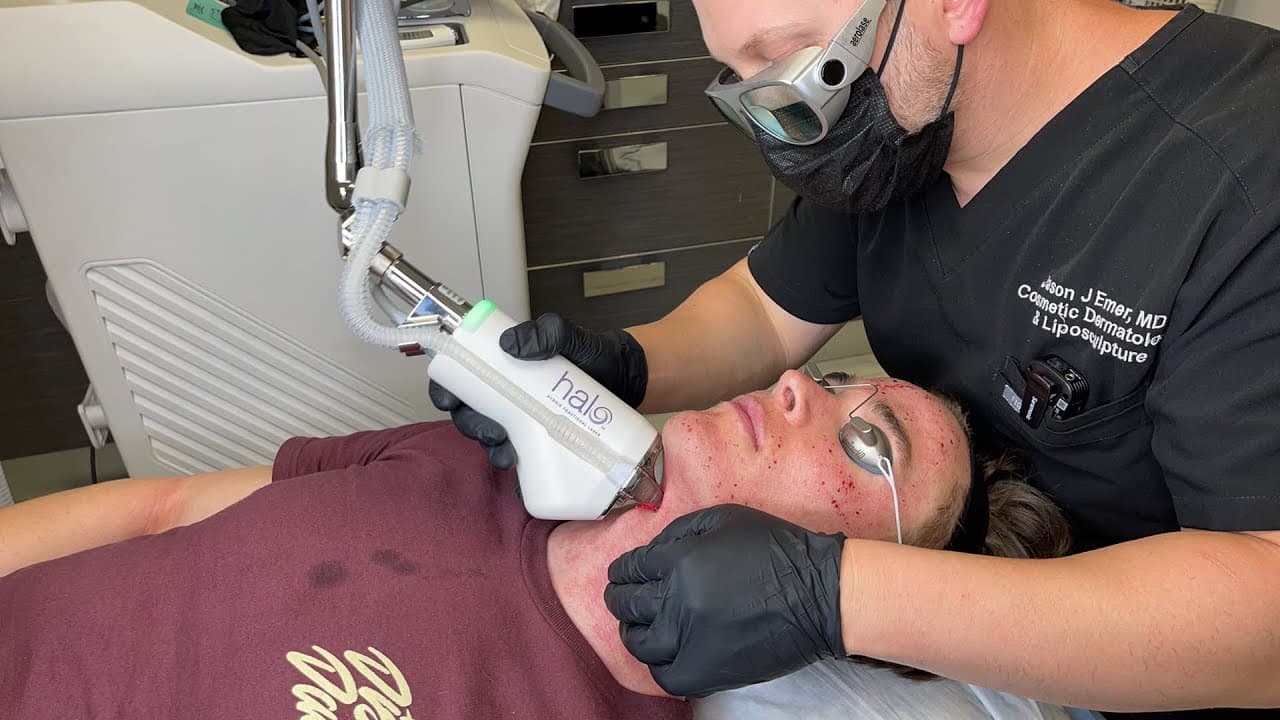 Watch a halo laser skin resurfacing procedure video