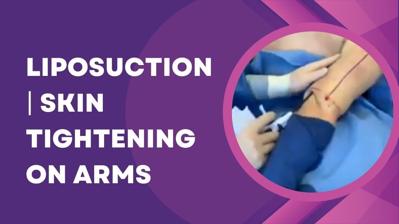 Watch a arm lift & tightening procedure video