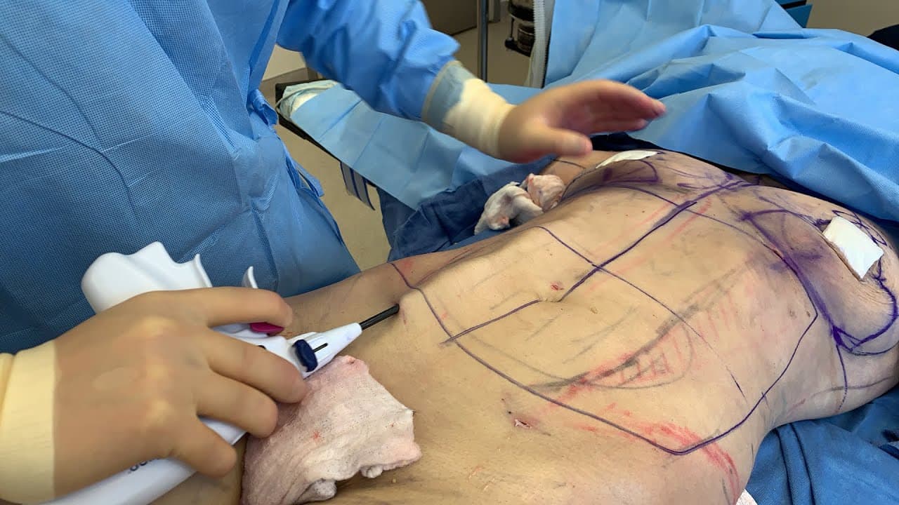 Watch a abdominal lipo for women procedure video