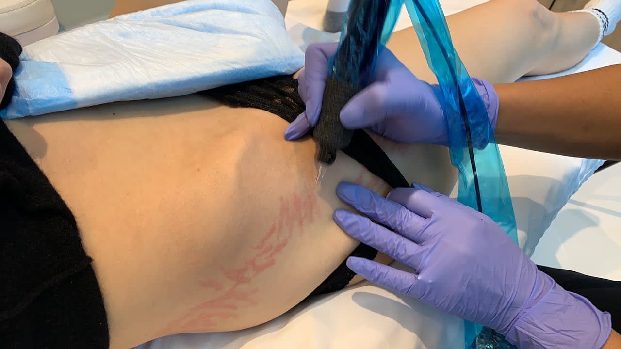 Watch a medical tattooing procedure video