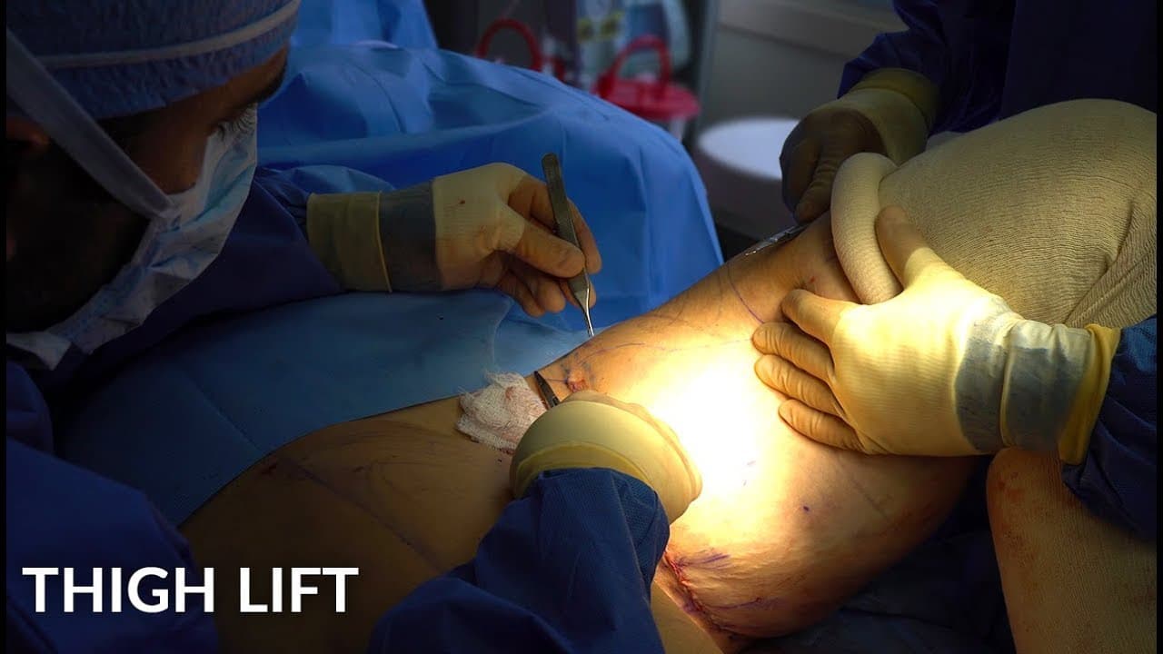 Thigh Lift & Tightening procedure video
