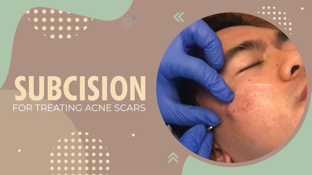 Watch a beverly hills for acne scar removal procedure video