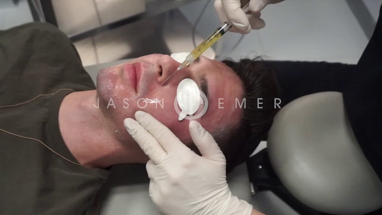 Watch a microneedling procedure video