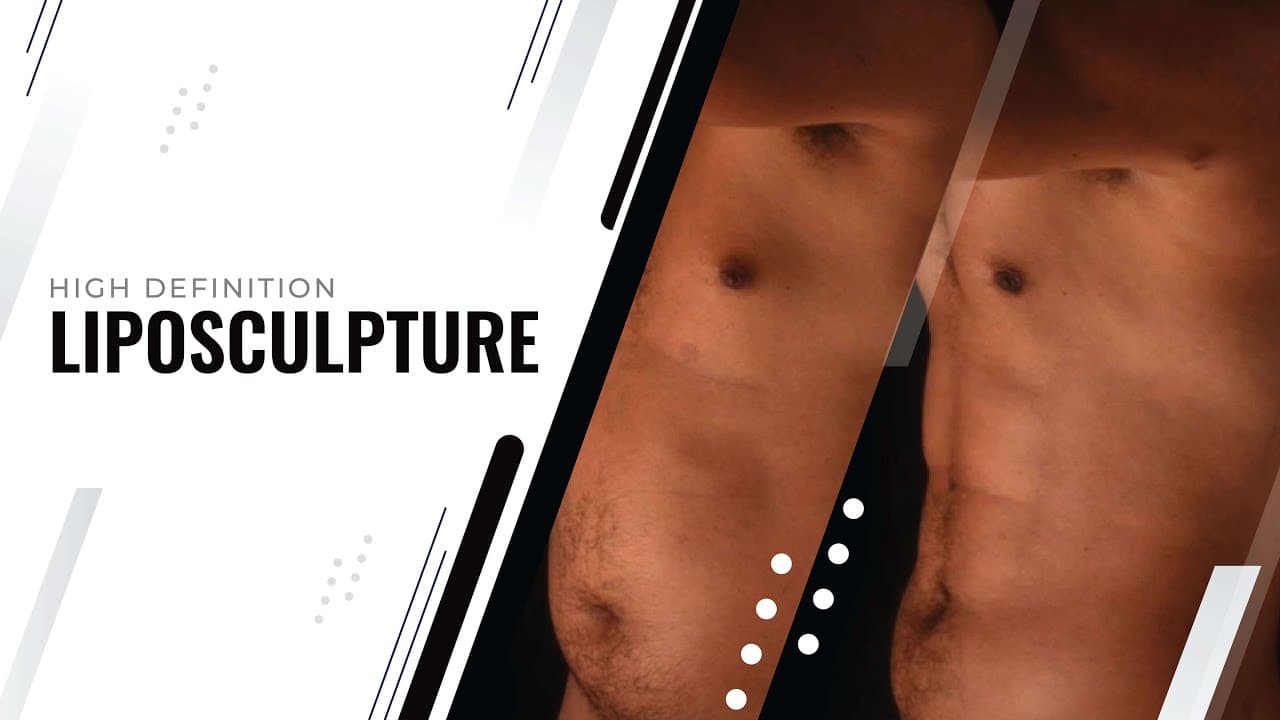 Watch a hd liposculpture for men procedure video