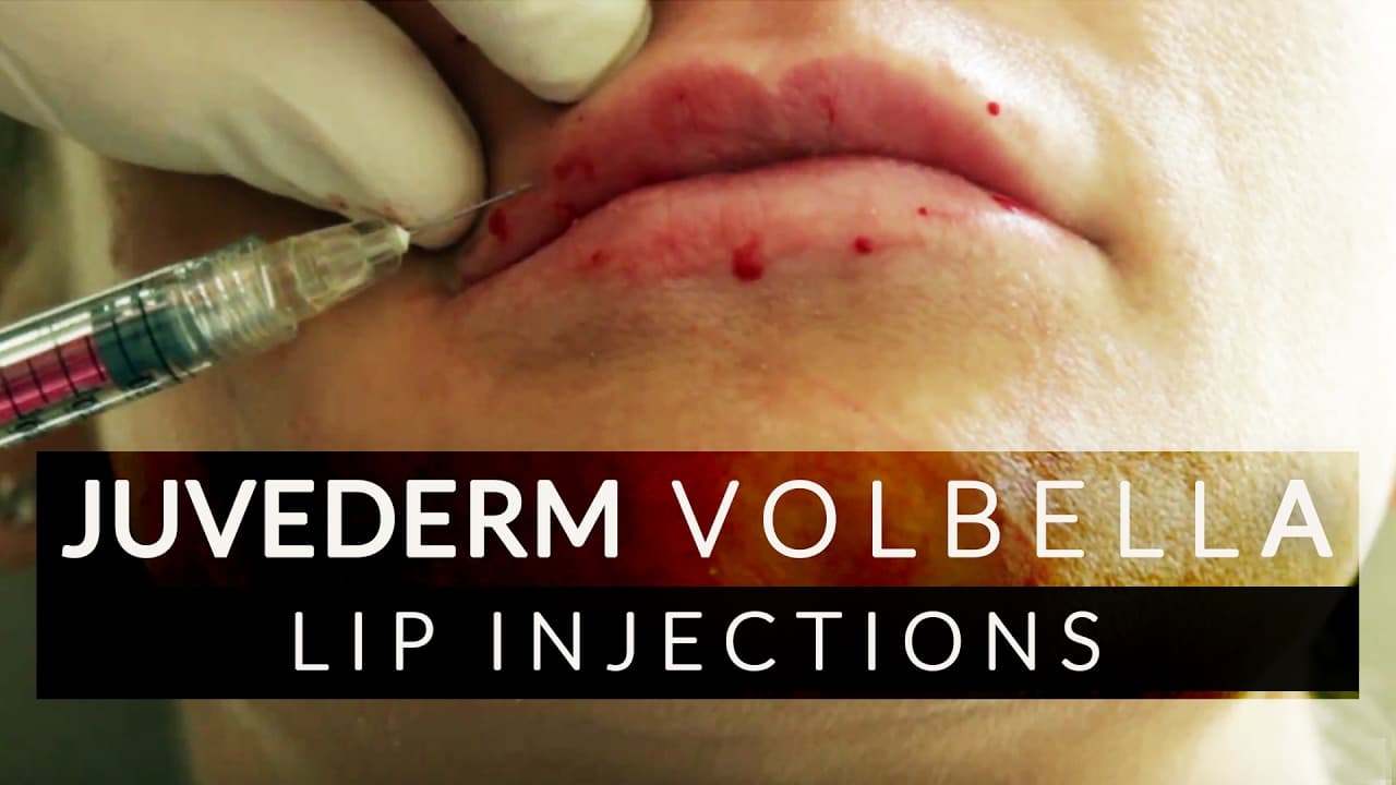 Watch a facial sculpting procedure video