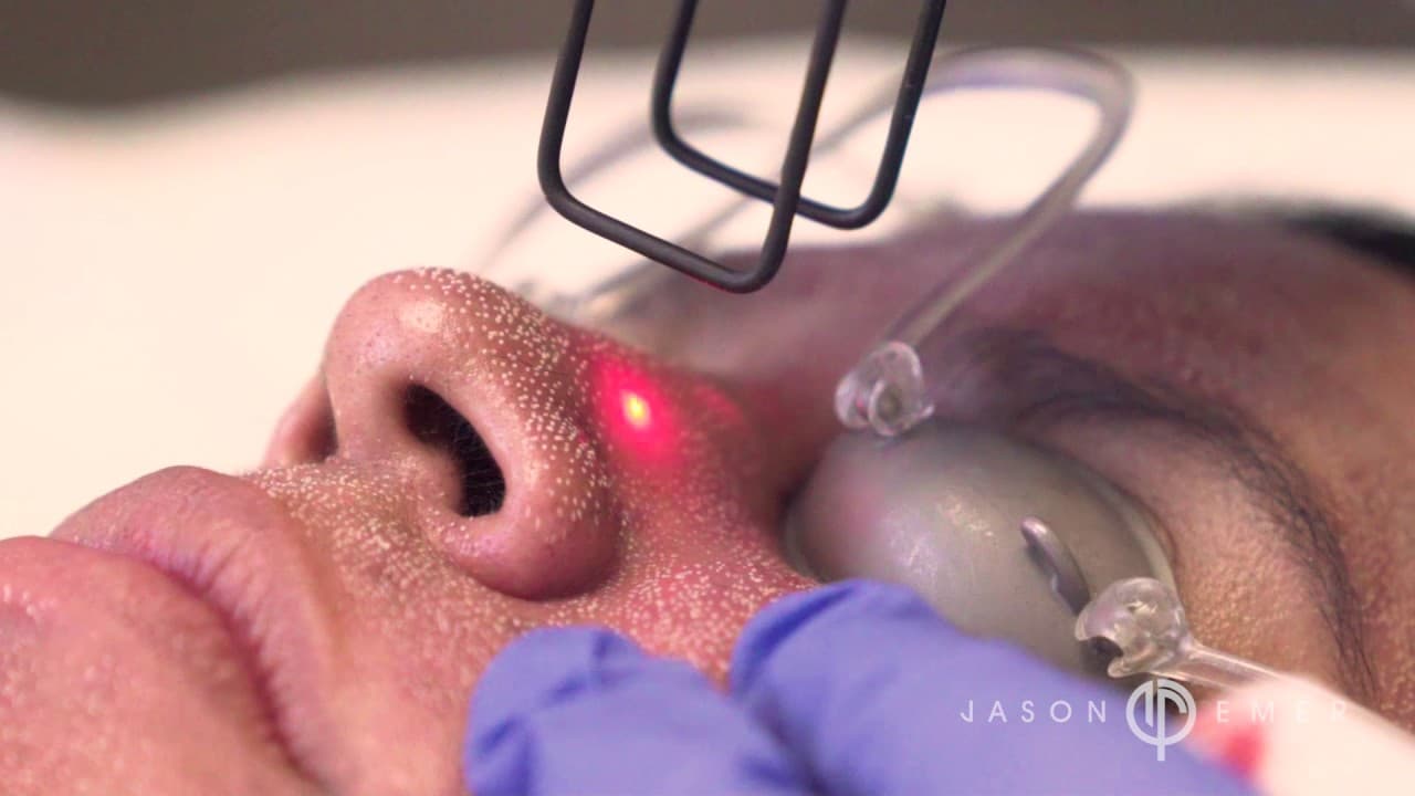 Watch a co2 laser resurfacing procedure video
