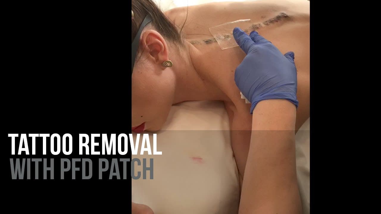 Watch a tattoo removal procedure video