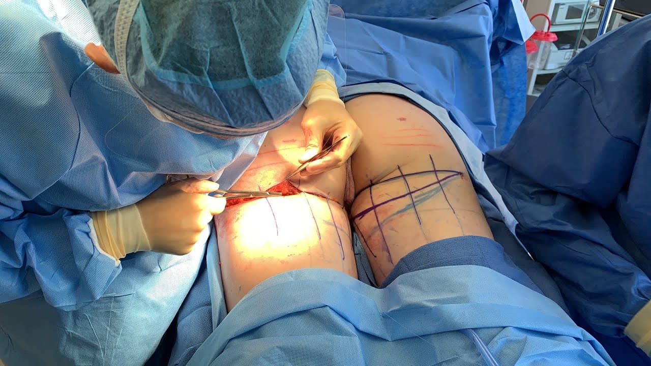 Watch a thigh lift & tightening for women procedure video