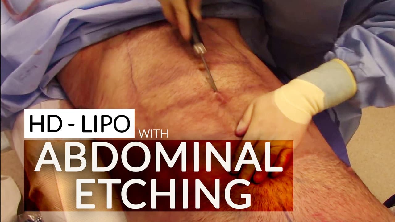 Watch a hd liposculpture for men procedure video