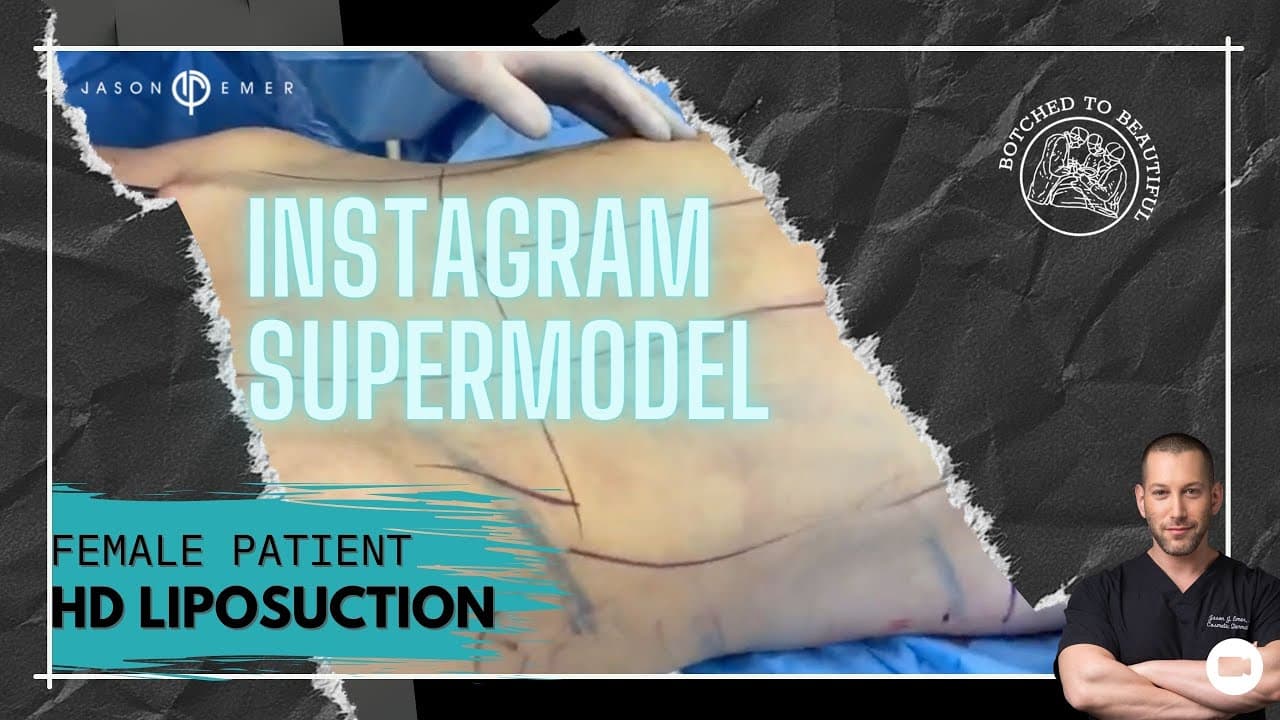 Watch a abdominal lipo for women procedure video