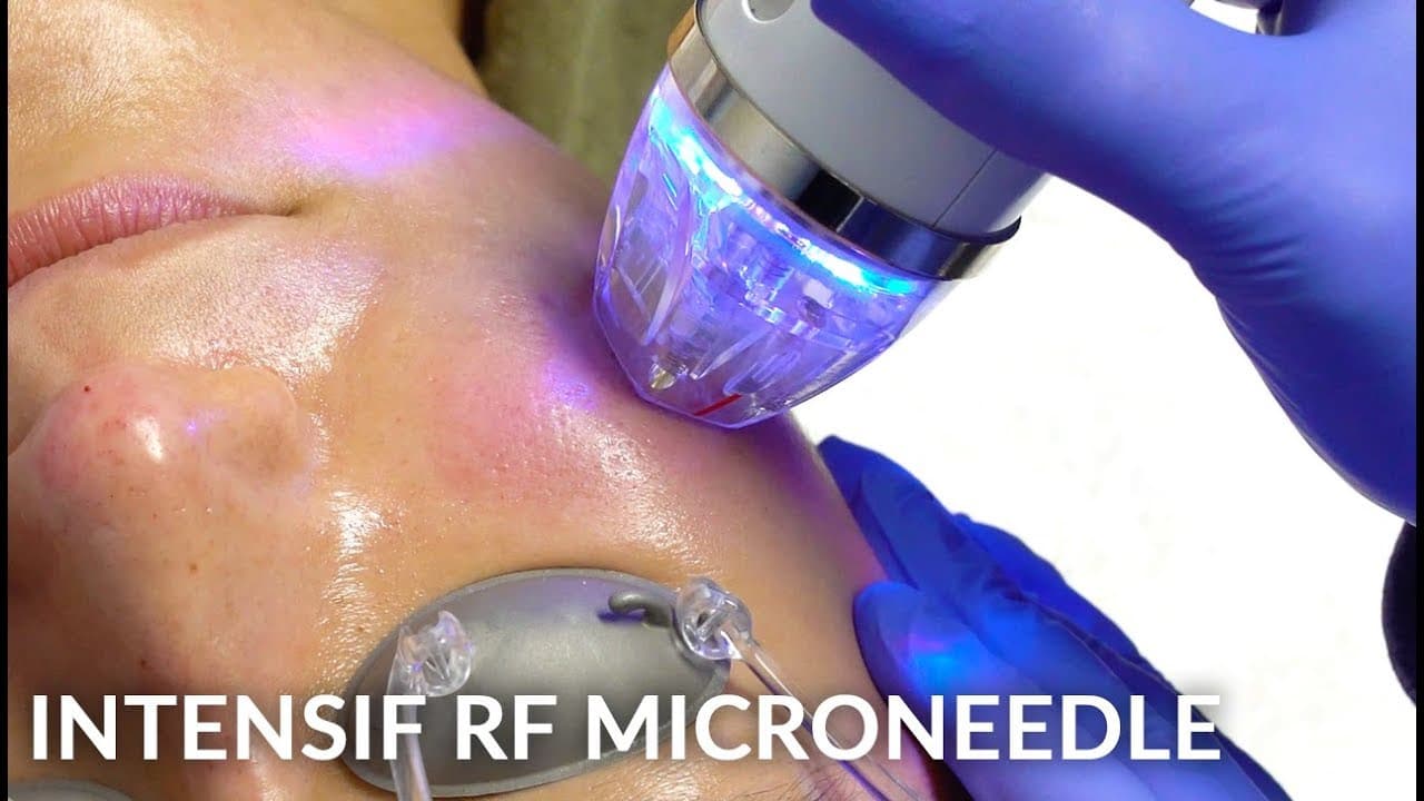 Watch a microneedling-old procedure video