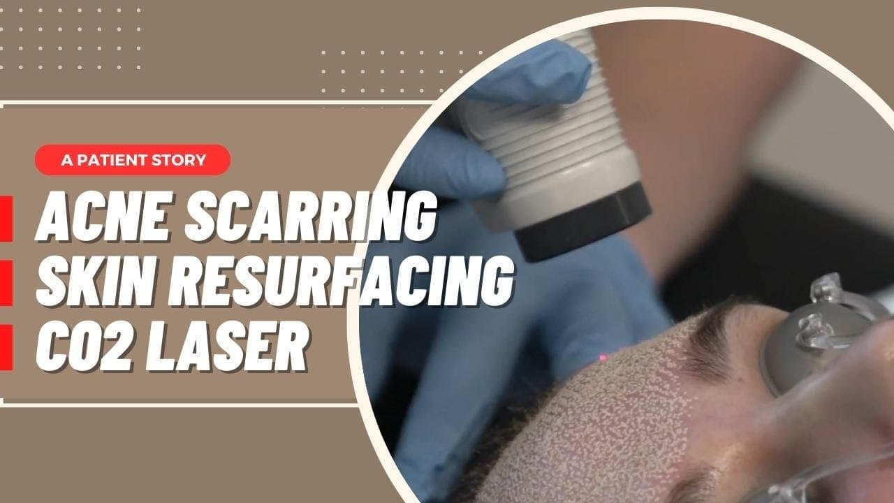 Acne Scar Treatments procedure video
