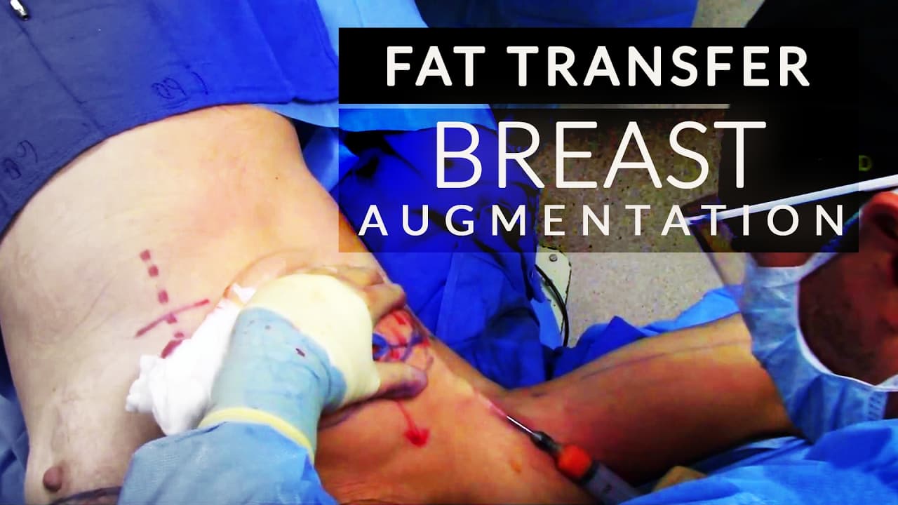 Watch a autologous fat grafting provides permanent volumization, shaping, sculpting, and muscular definition enhancements procedure video