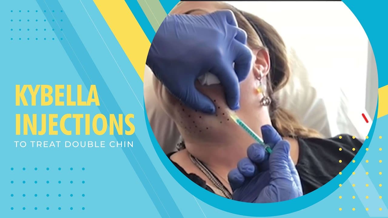 Watch a kybella procedure video