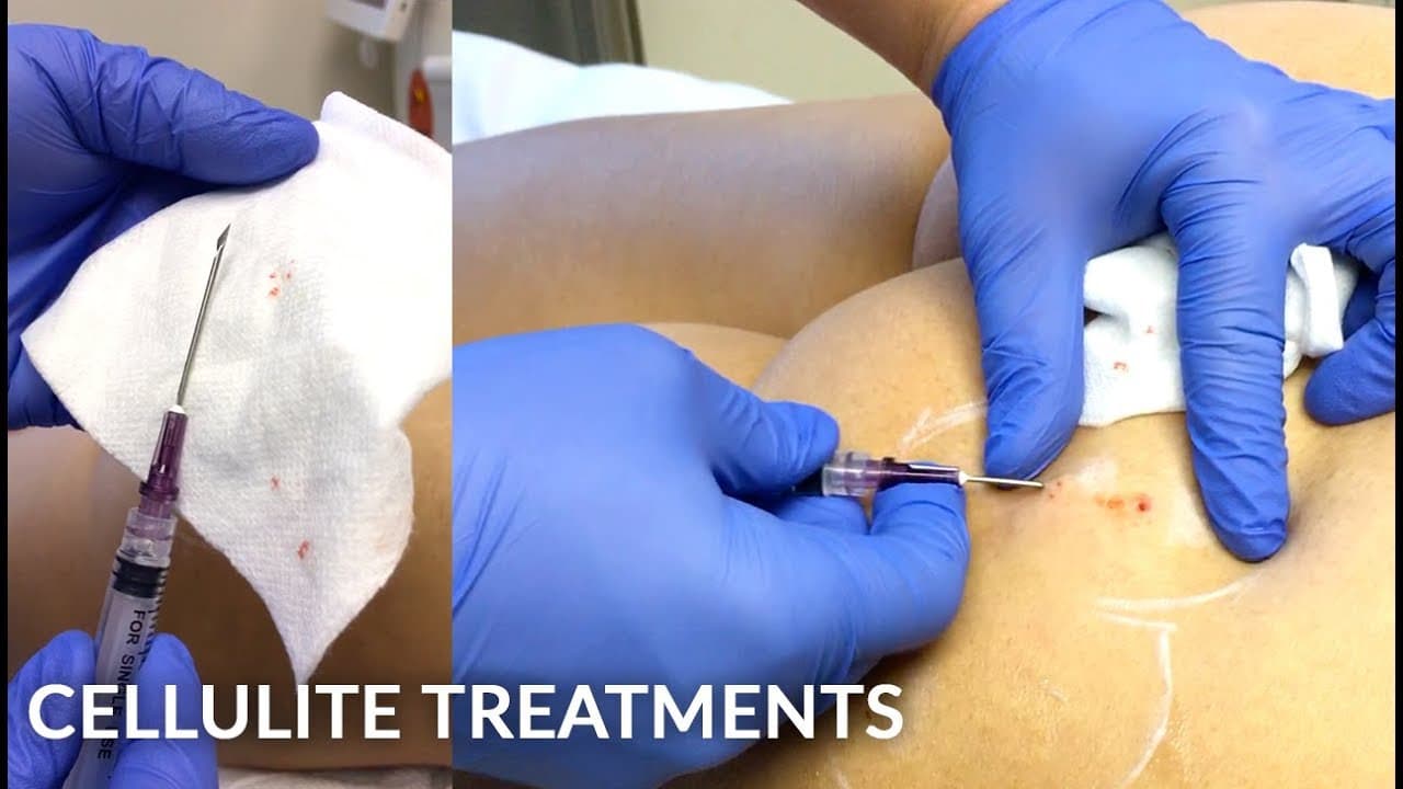 Watch a cellfina procedure video