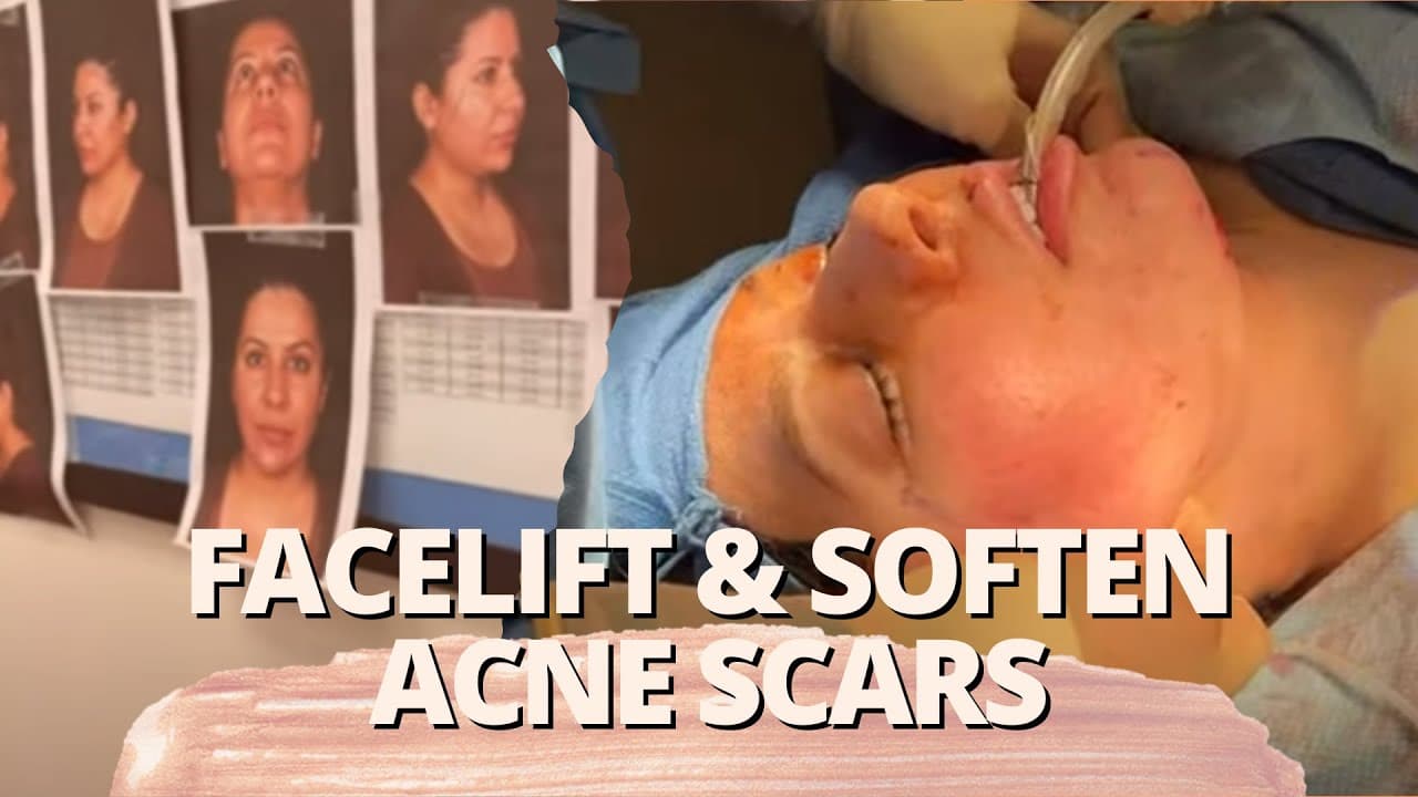 Watch a deep neck lift procedure video