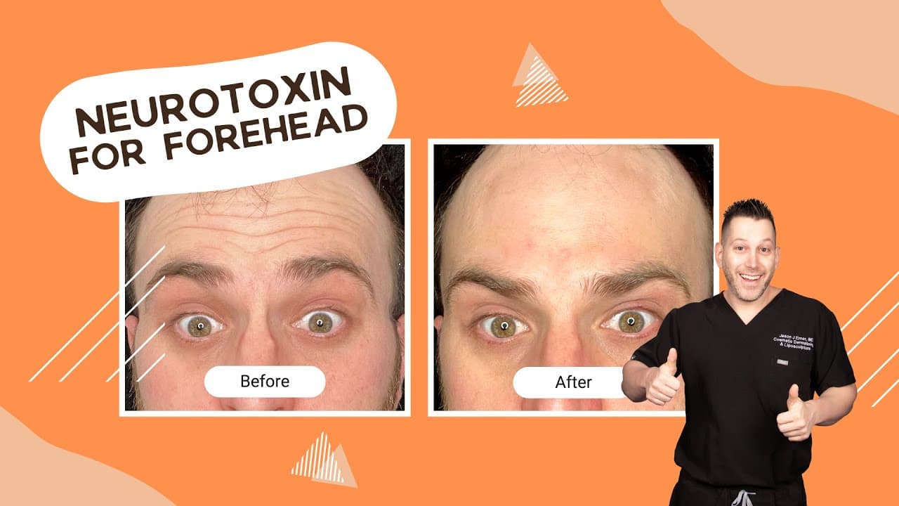 Watch a dysport procedure video