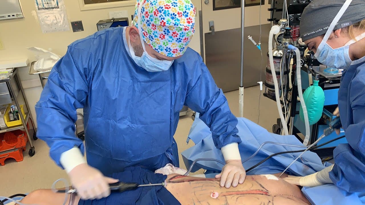 Watch a vaser liposuction procedure video