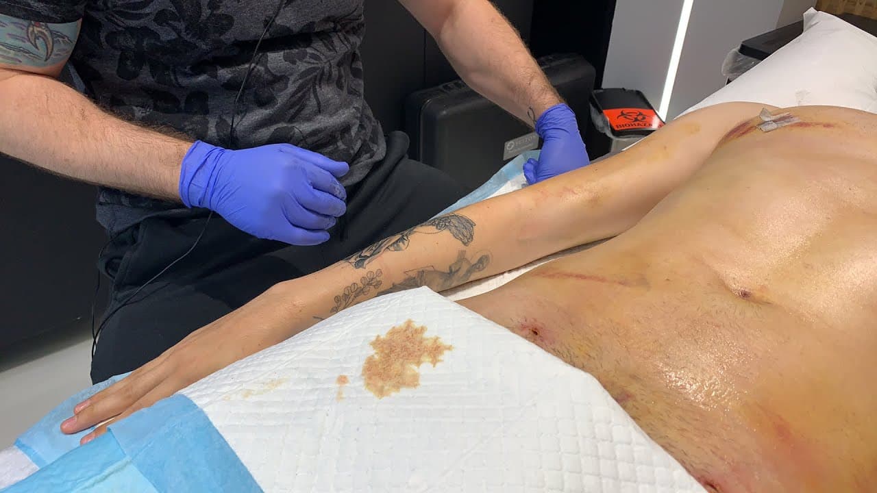 Watch a iv therapy procedure video