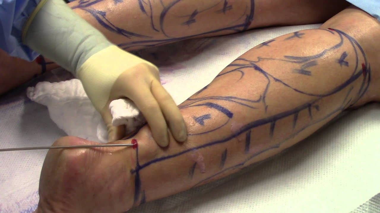 Watch a calf sculpting for women procedure video