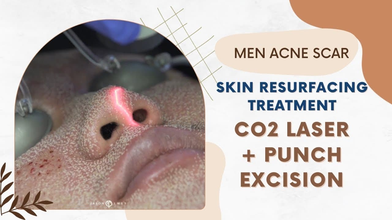 Watch a acne & general scarring procedure video