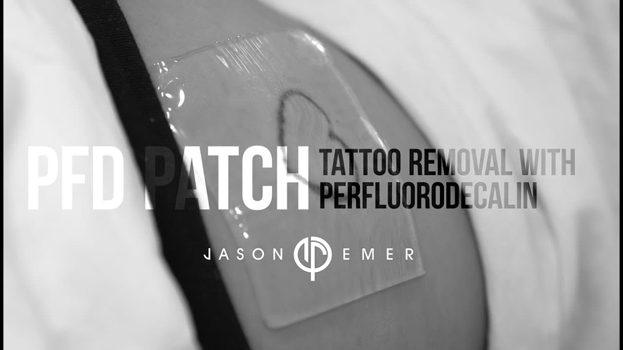 Watch a tattoo removal procedure video