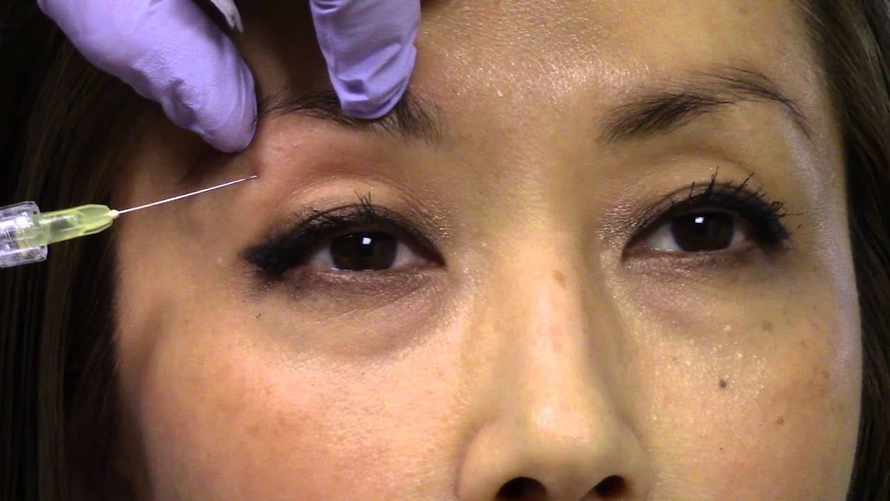 Watch a eyelid surgery procedure video