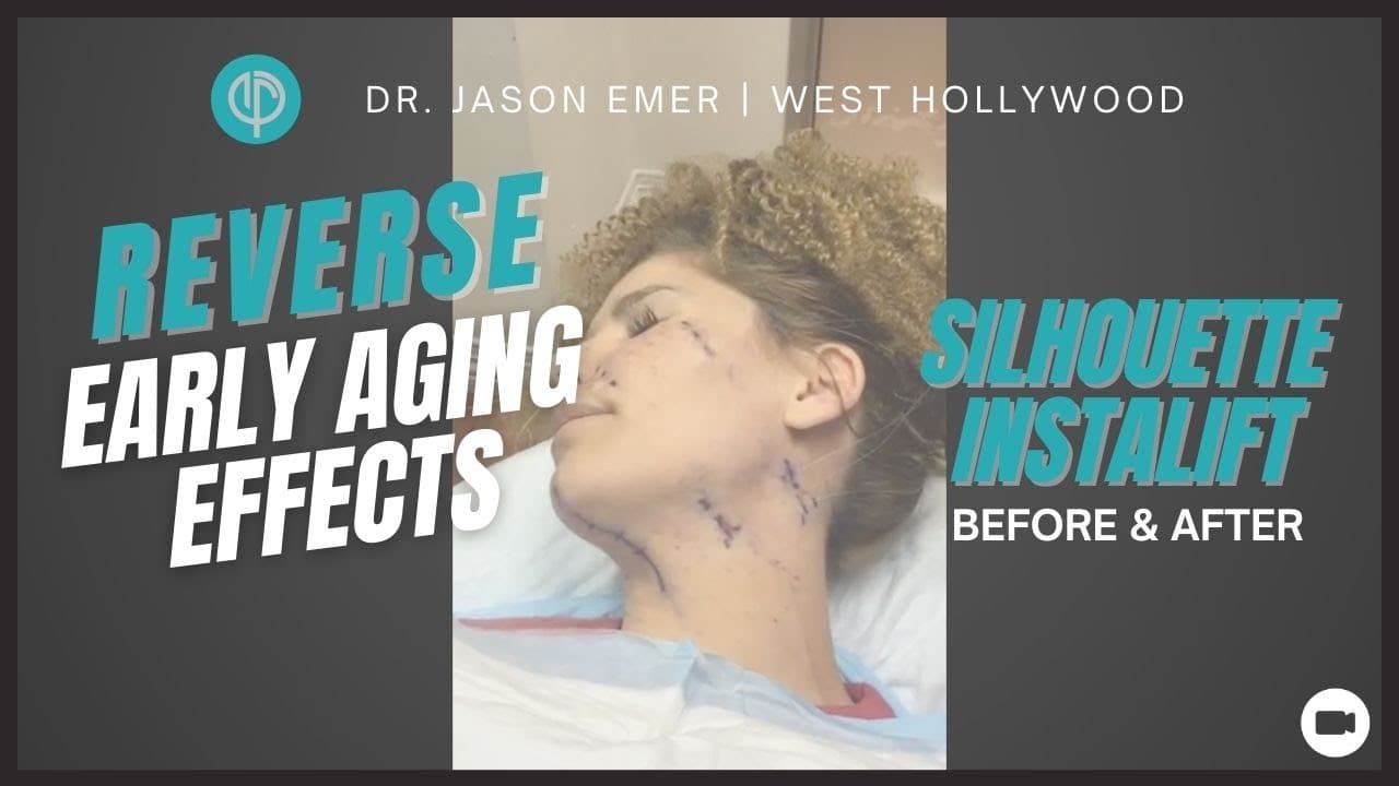 Watch a silhouette instalift procedure video