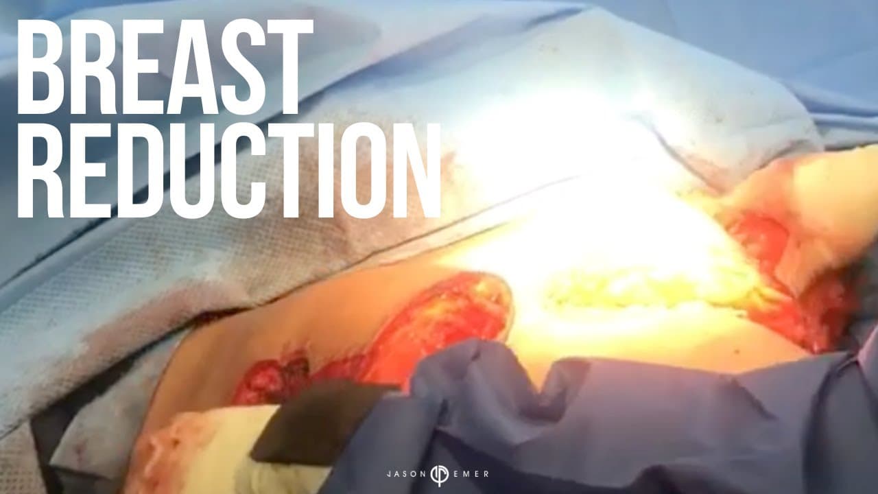 Watch a breast reduction without insurance procedure video