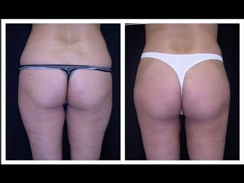 Watch a bellalift procedure video