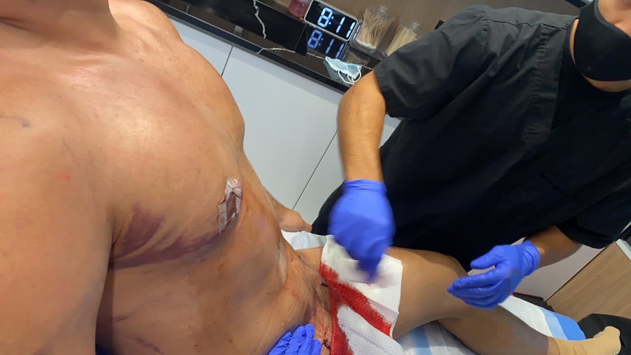 Watch a abdominal lipo for men procedure video