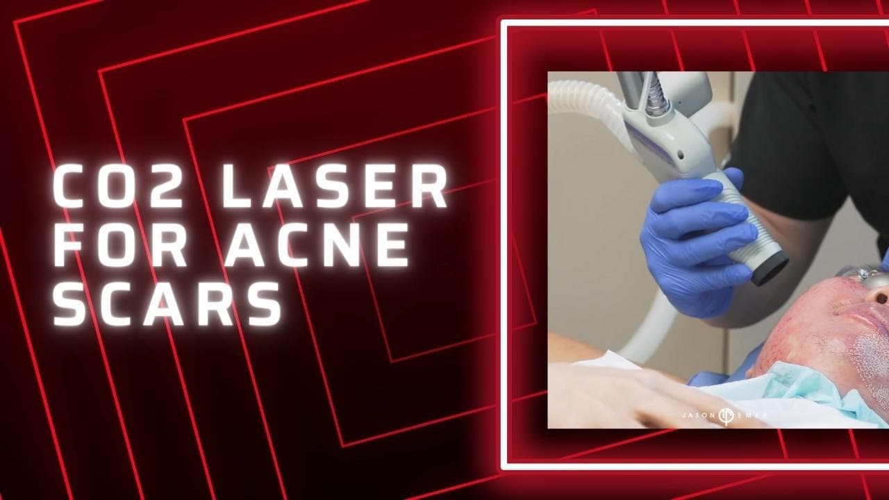 Watch a laser & rf skin resurfacing procedure video