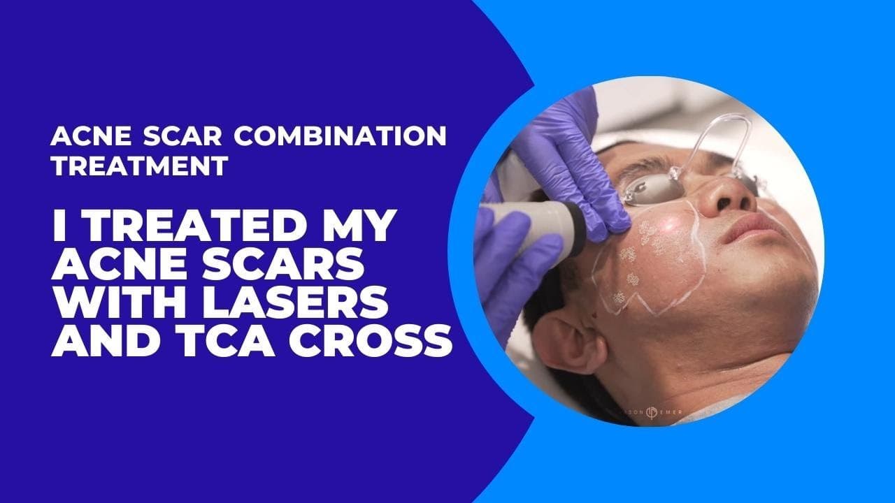 Acne Scar Treatments procedure video