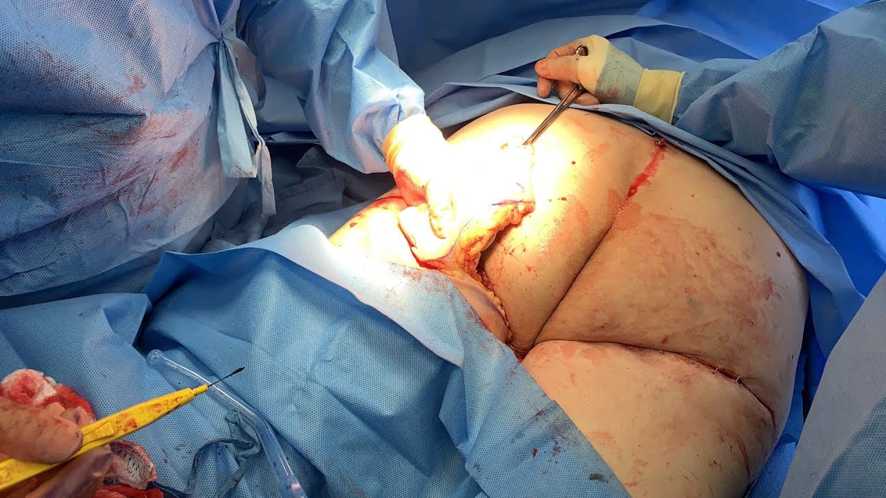 Watch a thigh lift & tightening for men procedure video