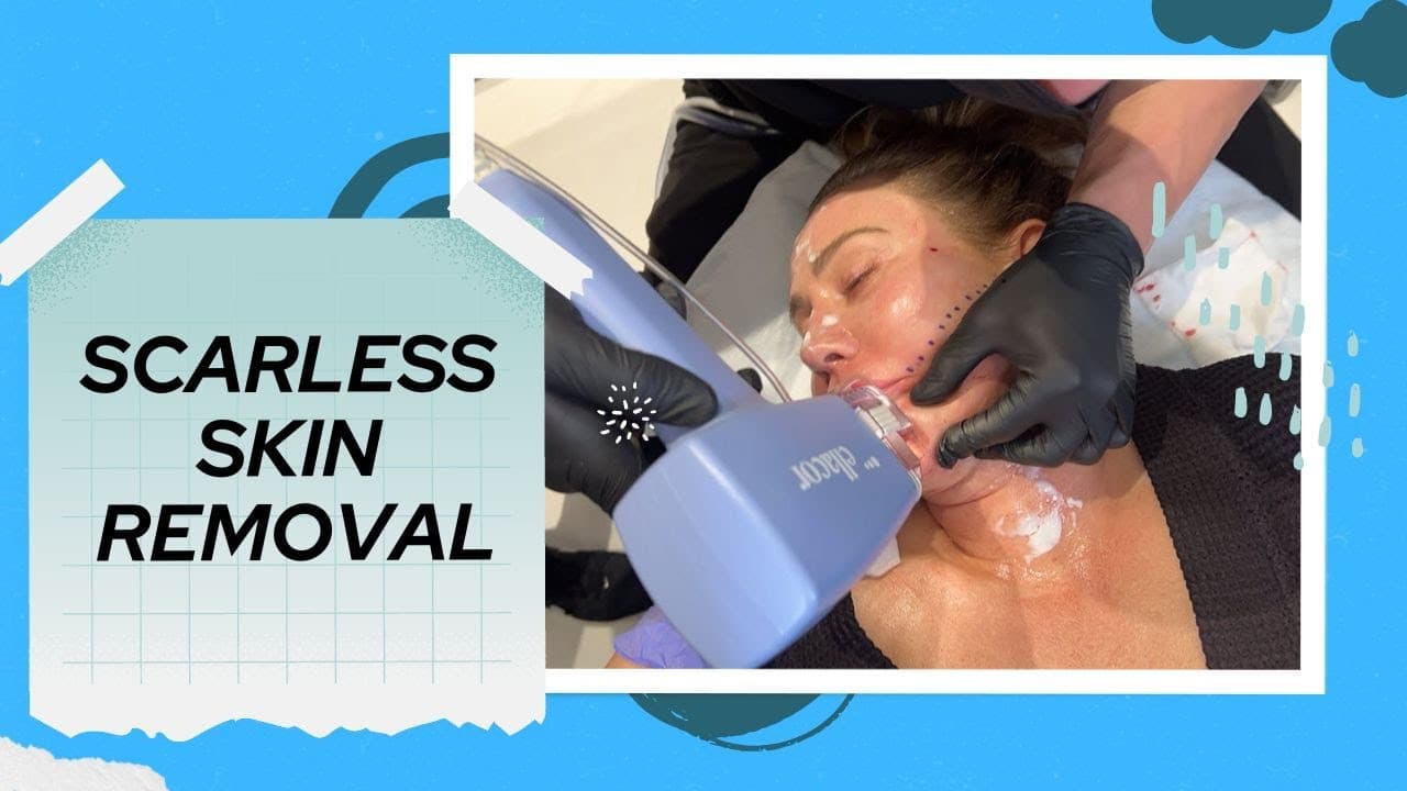 Watch a ellacor™ procedure video