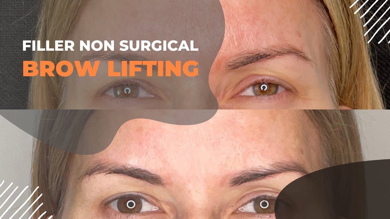 Watch a meshfill procedure video