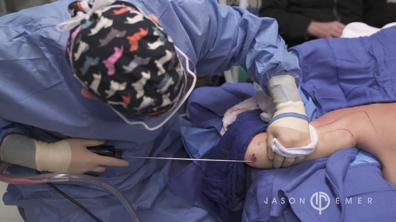 Watch a arm liposuction procedure video