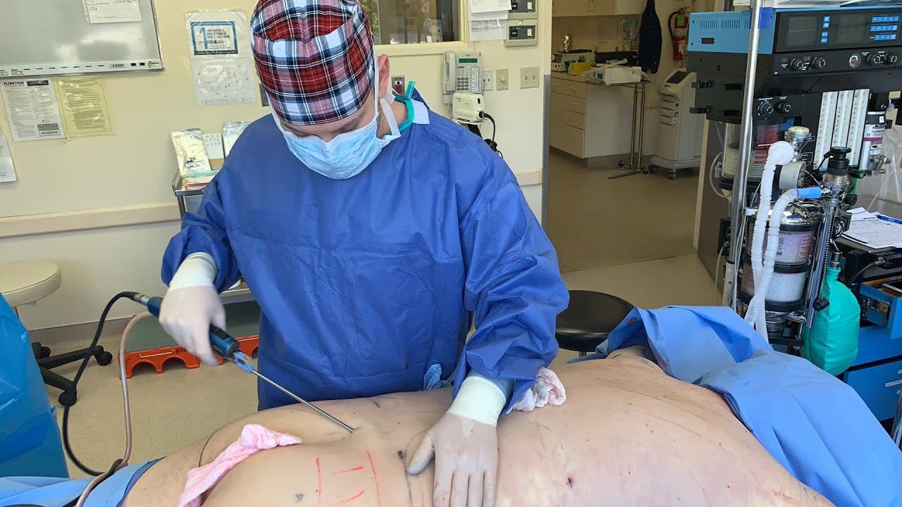 Back Lipo for Men procedure video