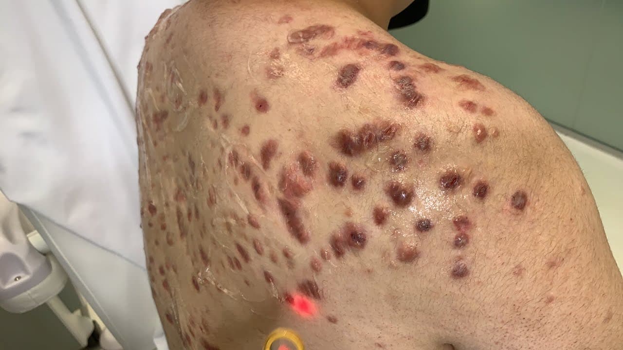 Watch a keloid treatment procedure video