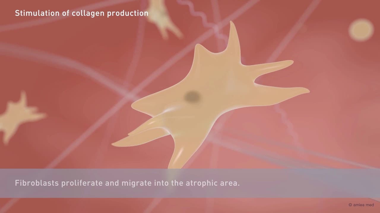 Acne Scar Treatments procedure video