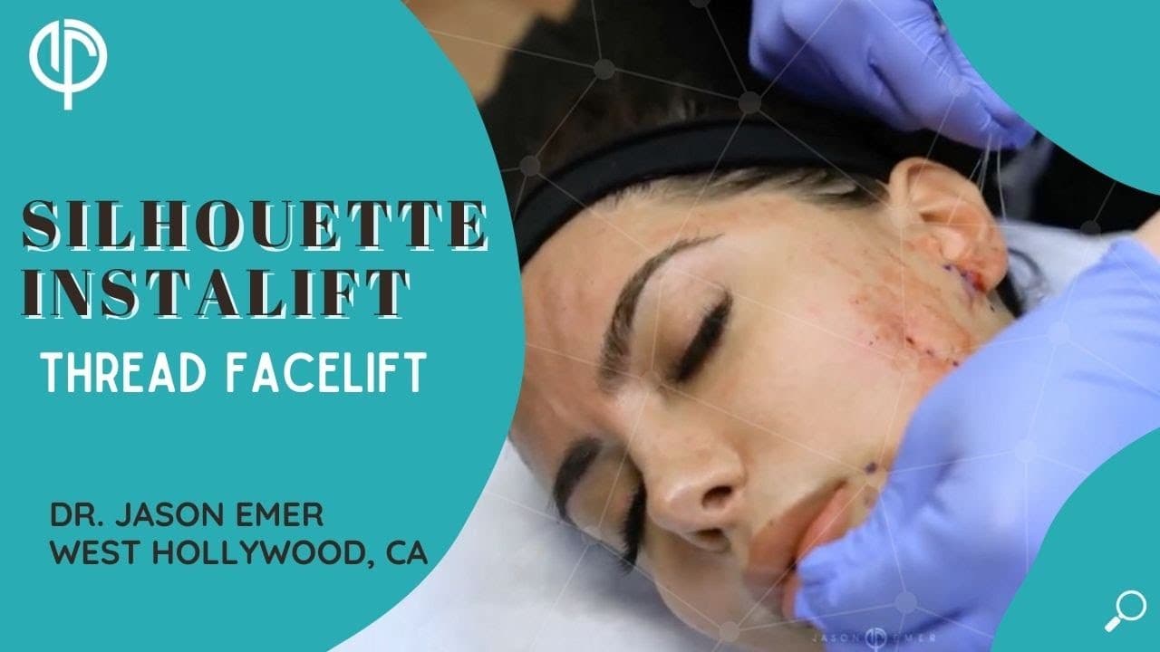 Watch a silhouette instalift procedure video