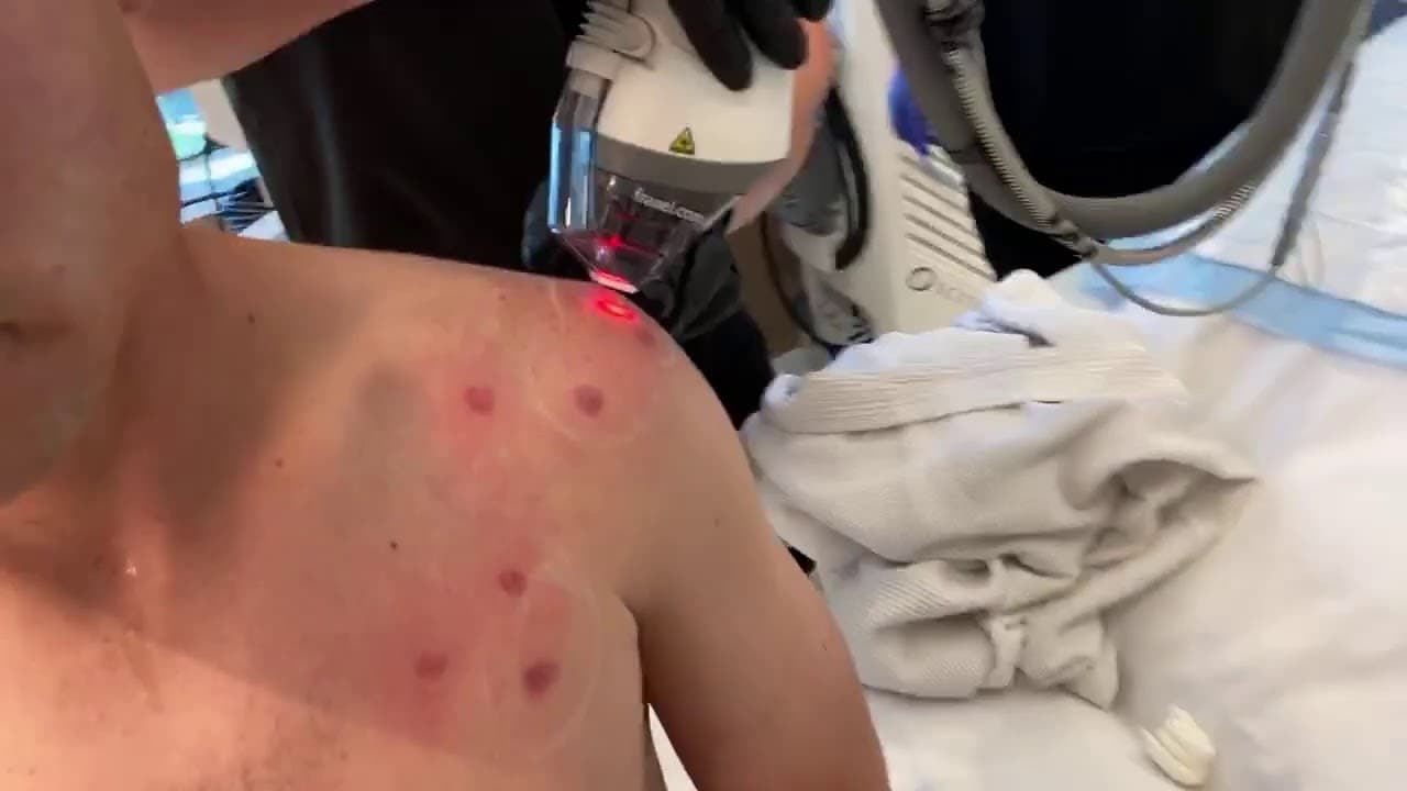 Watch a keloid treatment procedure video