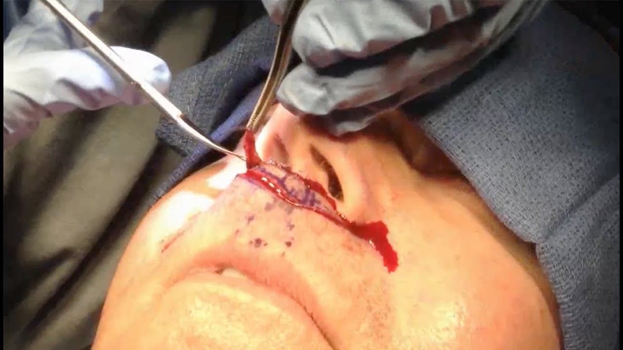 Watch a surgical lip lift procedure video