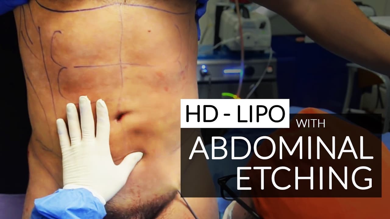 Watch a abdominal etching procedure video
